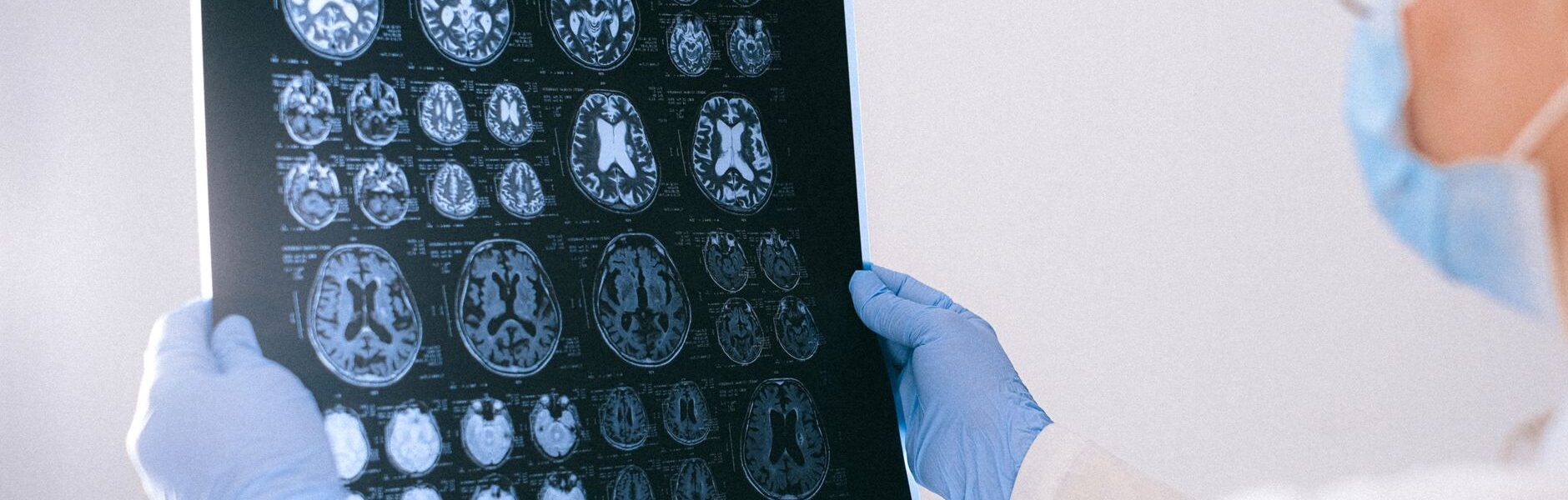 Alzheimer's disease treatment